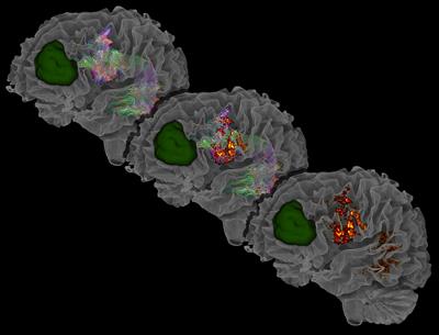 Tractography-based navigated TMS language mapping protocol